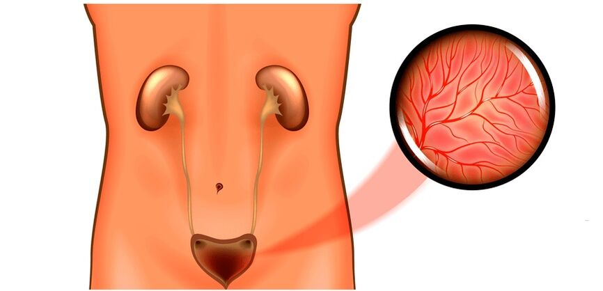 Cystitis in symptoms of men and treatment